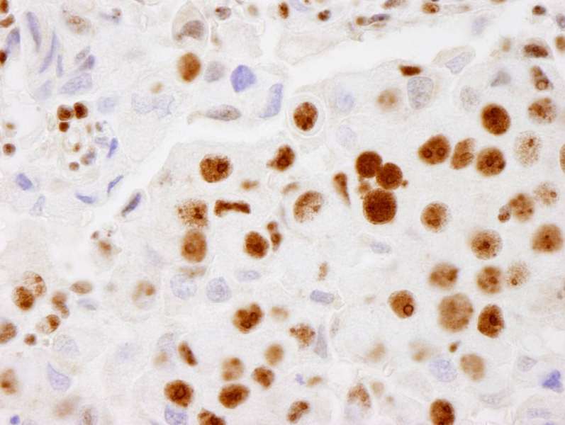 Detection of Human PELP1/MNAR by Immunohistochemistry. Sample: FFPE section of human breast adenocarcinoma. Antibody: Affinity purified rabbit anti-PELP1/MNAR used at a dilution of 1:500. Detection: DAB.