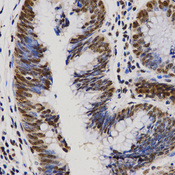 Immunohistochemistry of paraffin-embedded human rectal cancer tissue using PELP1 antibody at dilution of 1:200 (x400 lens).