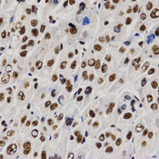 Immunohistochemistry of paraffin-embedded human liver cancer tissue using PELP1 antibody at dilution of 1:200 (x400 lens).