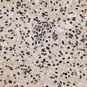 Immunohistochemistry of paraffin-embedded human liver fibrosis tissue using PELP1 antibody at dilution of 1:200 (x400 lens)