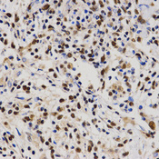 Immunohistochemistry of paraffin-embedded human lung cancer tissue using PELP1 antibody at dilution of 1:200 (x400 lens).