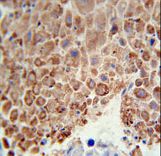 PHGDH Antibody immunohistochemistry of formalin-fixed and paraffin-embedded human hepatocarcinoma followed by peroxidase-conjugated secondary antibody and DAB staining.