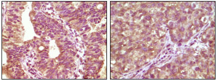 BRAF staining in bladder and lung cancers. Paraffin-embedded human bladder carcinoma (left) and human lung carcinoma (right) tissues are stained with BRAF (1F12) Antibody (Cat. No. 252640) used at 1:200 dilution.