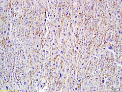 HYAL1 staining in hepatocarcinoma. Formalin-fixed paraffin-embedded human hepatocarcinoma tissue is stained with Hyaluronidase-1 Antibody (Cat. No. 254526) used at 1:200 dilution.