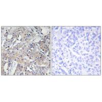 Immunohistochemistry analysis of paraffin-embedded human breast carcinoma tissue using Collagen VI α3 antibody #34209.
