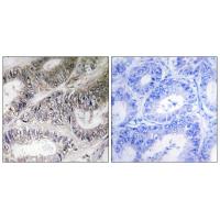 Immunohistochemistry analysis of paraffin-embedded human colon carcinoma tissue using COX19 antibody #34221.
