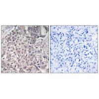 Immunohistochemistry analysis of paraffin-embedded human liver carcinoma tissue using Cytochrome P450 4F2 antibody #34244.