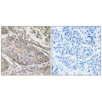 Immunohistochemistry analysis of paraffin-embedded human lung carcinoma tissue using PLA2G4E antibody #34639.
