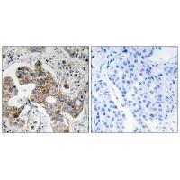 Immunohistochemistry analysis of paraffin-embedded human breast carcinoma tissue using KCNK15 antibody #34912.