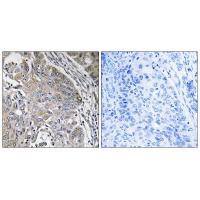 Immunohistochemistry analysis of paraffin-embedded human lung carcinoma tissue using SPINK6 antibody #35018.