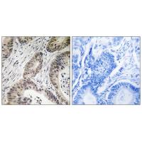 Immunohistochemistry analysis of paraffin-embedded human colon carcinoma tissue using TUT1 antibody #35114.