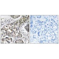 Immunohistochemistry analysis of paraffin-embedded human breast carcinoma tissue using USP6NL antibody #35136.