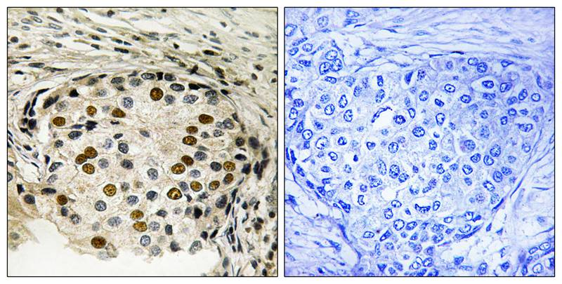 Immunohistochemical analysis of paraffin-embedded human breast carcinoma tissue using OSR1 (Phospho-Thr185) antibody #11746 (left)or the same antibody preincubated with blocking peptide (right).
