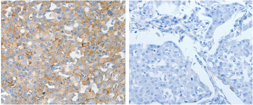The image on the left is immunohistochemistry of paraffin-embedded Human breast cancer tissue using 31230 (BPIFB2 Antibody) at dilution 1/50, on the right is treated with the synthetic peptide.