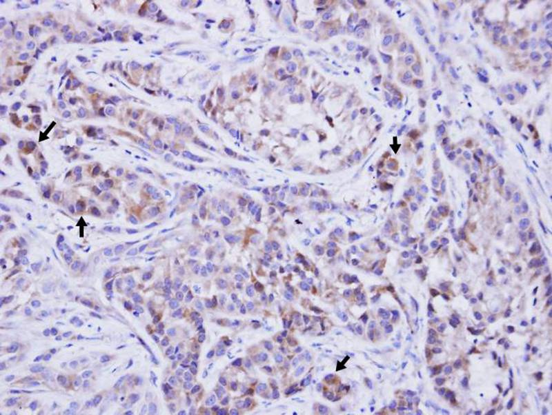 Immunohistochemical analysis of paraffin-embedded xenograft, using TTLL1 antibody at 1: 500 dilution.