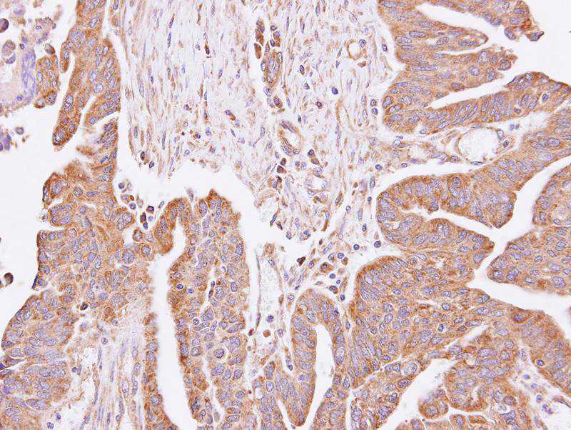 Immunohistochemical analysis of paraffin-embedded Lung AdC, using LOC55286 antibody at 1: 100 dilution.