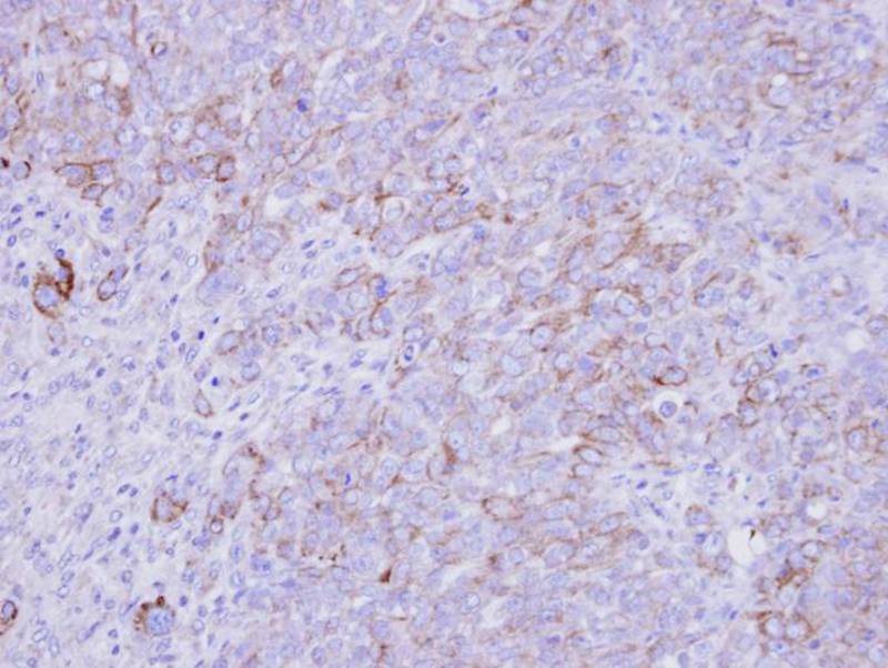 Immunohistochemical analysis of paraffin-embedded DLD-1 xenograft, using SLC26A8 antibody at 1: 500 dilution.