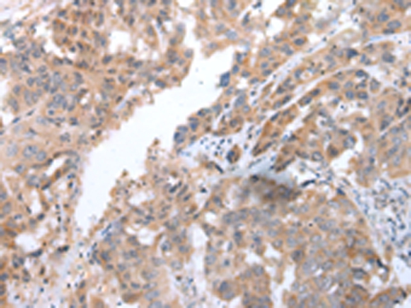 Immunohistochemical analysis of paraffin-embedded Human breast cancer tissue using #43250 at dilution 1/40.
