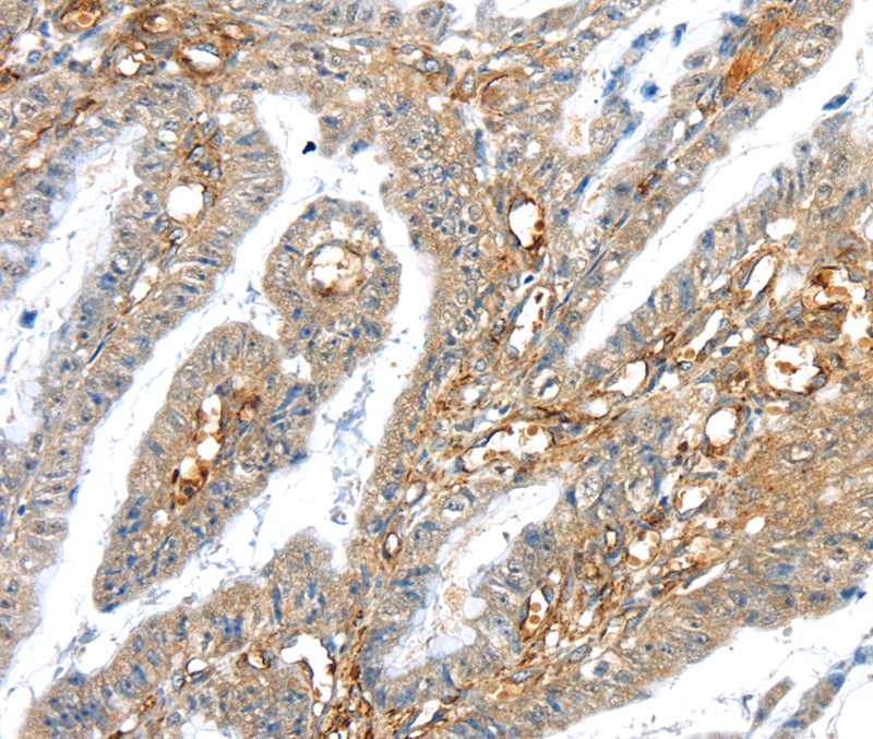 Immunohistochemical analysis of paraffin-embedded Human esophagus cancer tissue using #40392 at dilution 1/30.