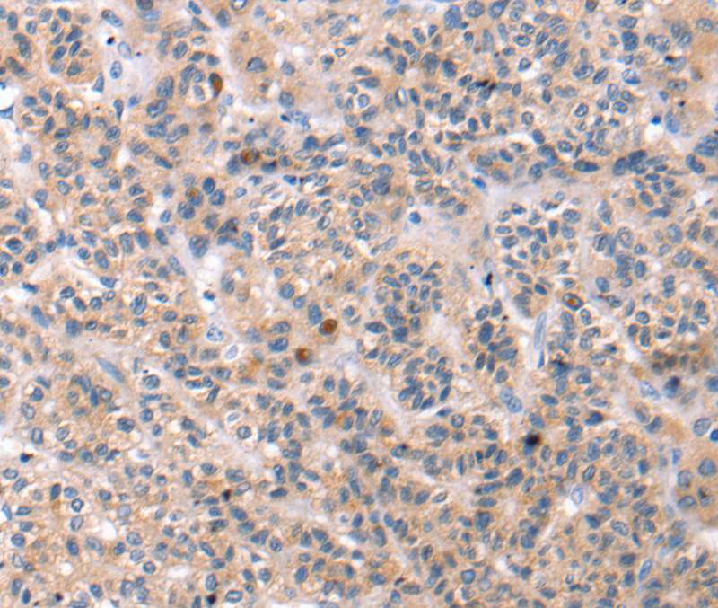Immunohistochemical analysis of paraffin-embedded Human liver cancer tissue using #40240 at dilution 1/30.