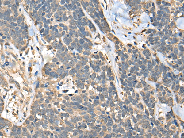 The image on the left is immunohistochemistry of paraffin-embedded Human thyroid cancer tissue using 46362(C14orf80 Antibody) at dilution 1/35, on the right is treated with fusion protein. (Original magnification: x200)
