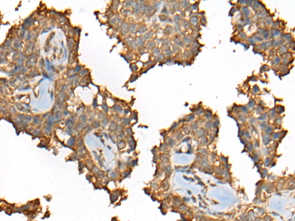 The image on the left is immunohistochemistry of paraffin-embedded Human ovarian cancer tissue using 46362(C14orf80 Antibody) at dilution 1/35, on the right is treated with fusion protein. (Original magnification: x200)