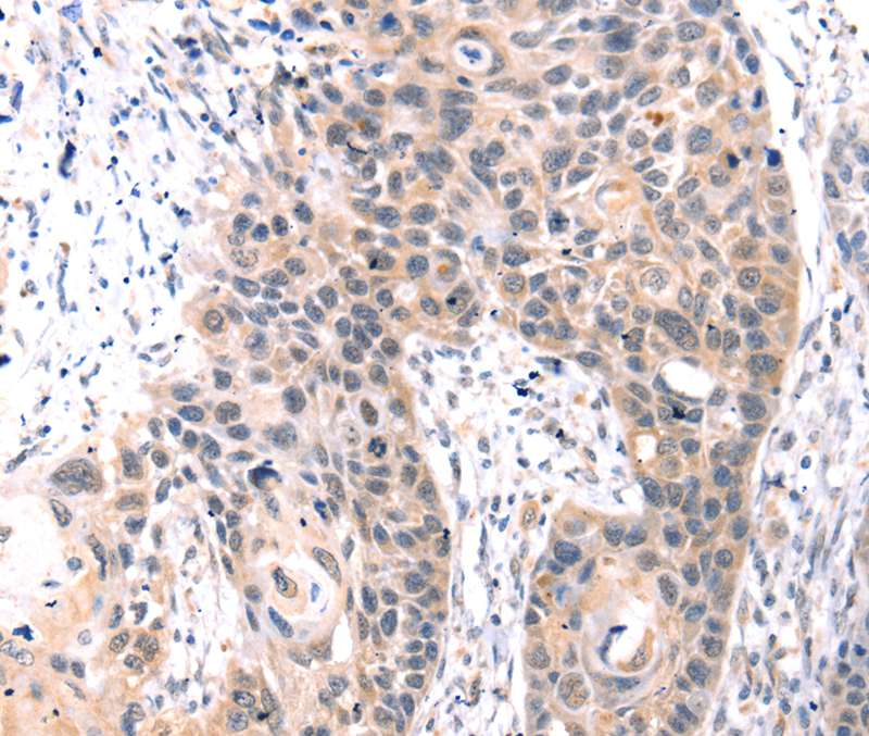 Immunohistochemical analysis of paraffin-embedded Human esophagus cancer tissue using #40240 at dilution 1/30.