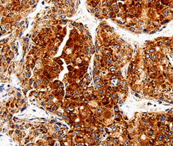 Immunohistochemical analysis of paraffin-embedded Human thyroid cancer tissue using #35585 at dilution 1/50.