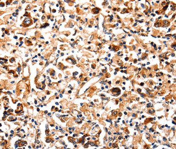 Immunohistochemical analysis of paraffin-embedded Human colon cancer tissue using #35584 at dilution 1/12.