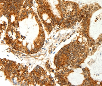Immunohistochemical analysis of paraffin-embedded Human colon cancer tissue using #35581 at dilution 1/60.