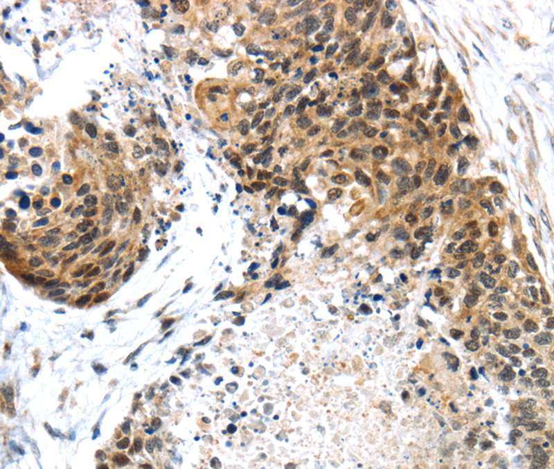 Immunohistochemical analysis of paraffin-embedded Human esophagus cancer tissue using #40168 at dilution 1/45.