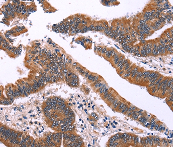 Immunohistochemical analysis of paraffin-embedded Human colon cancer tissue using #35789 at dilution 1/40.