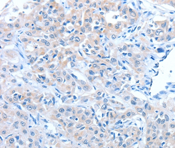 Immunohistochemical analysis of paraffin-embedded Human lung cancer tissue using #36042 at dilution 1/30.