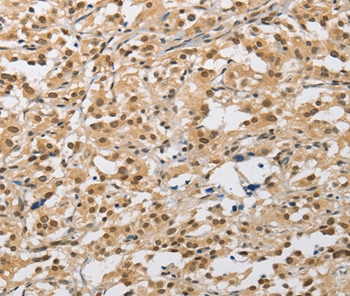 Immunohistochemical analysis of paraffin-embedded Human thyroid cancer tissue using #36126 at dilution 1/40.