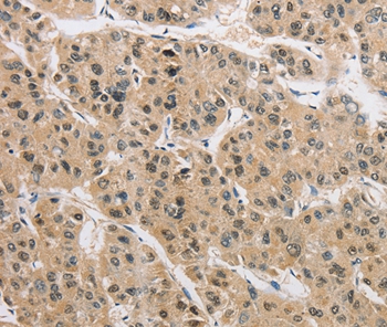 Immunohistochemical analysis of paraffin-embedded Human liver cancer tissue using #36126 at dilution 1/40.