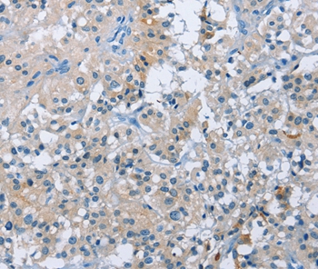 Immunohistochemical analysis of paraffin-embedded Human thyroid cancer tissue using #36293 at dilution 1/50.
