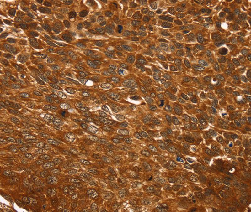 Immunohistochemical analysis of paraffin-embedded Human esophagus cancer tissue using #40379 at dilution 1/25.