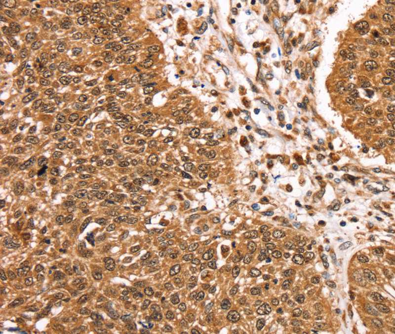 Immunohistochemical analysis of paraffin-embedded Human lung cancer tissue using #40379 at dilution 1/25.