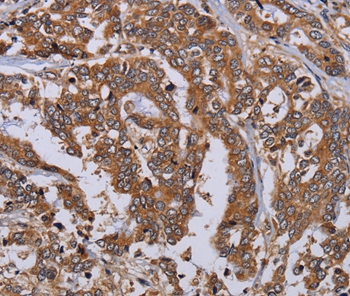 Immunohistochemical analysis of paraffin-embedded Human liver cancer tissue using #36612 at dilution 1/50.