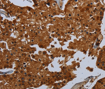 Immunohistochemical analysis of paraffin-embedded Human prostate cancer tissue using #36615 at dilution 1/60.