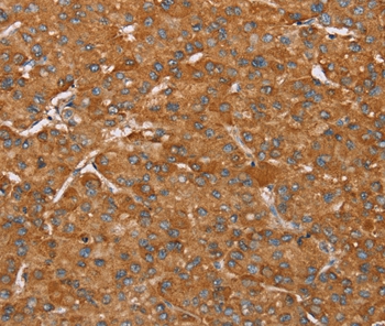 Immunohistochemical analysis of paraffin-embedded Human liver cancer tissue using #36676 at dilution 1/55.