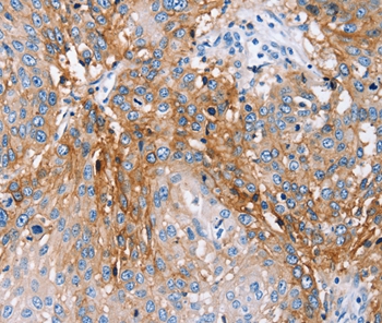 Immunohistochemical analysis of paraffin-embedded Human lung cancer tissue using #36697 at dilution 1/25.