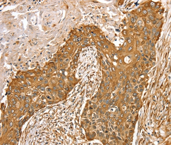 Immunohistochemical analysis of paraffin-embedded Human esophagus cancer tissue using #36714 at dilution 1/45.