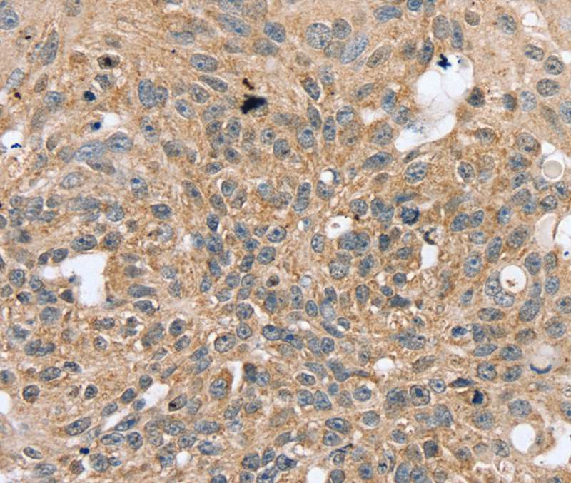 Immunohistochemical analysis of paraffin-embedded Human breast cancer tissue using #40070 at dilution 1/20.