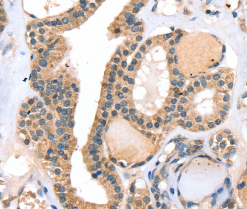 Immunohistochemical analysis of paraffin-embedded Human thyroid cancer tissue using #40070 at dilution 1/20.