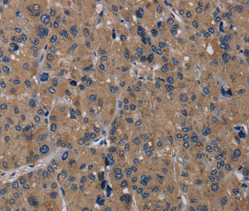 Immunohistochemical analysis of paraffin-embedded Human liver cancer tissue using #36874 at dilution 1/20.