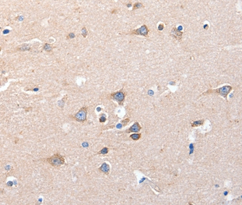Immunohistochemical analysis of paraffin-embedded Human brain cancer tissue using #36921 at dilution 1/15.