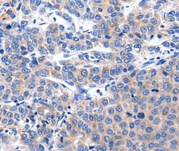Immunohistochemical analysis of paraffin-embedded Human liver cancer tissue using #36921 at dilution 1/15.