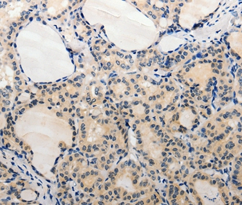 Immunohistochemical analysis of paraffin-embedded Human thyroid cancer tissue using #37083 at dilution 1/20.