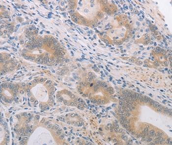 Immunohistochemical analysis of paraffin-embedded Human gastric cancer tissue using #37104 at dilution 1/60.